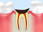C4末期の虫歯